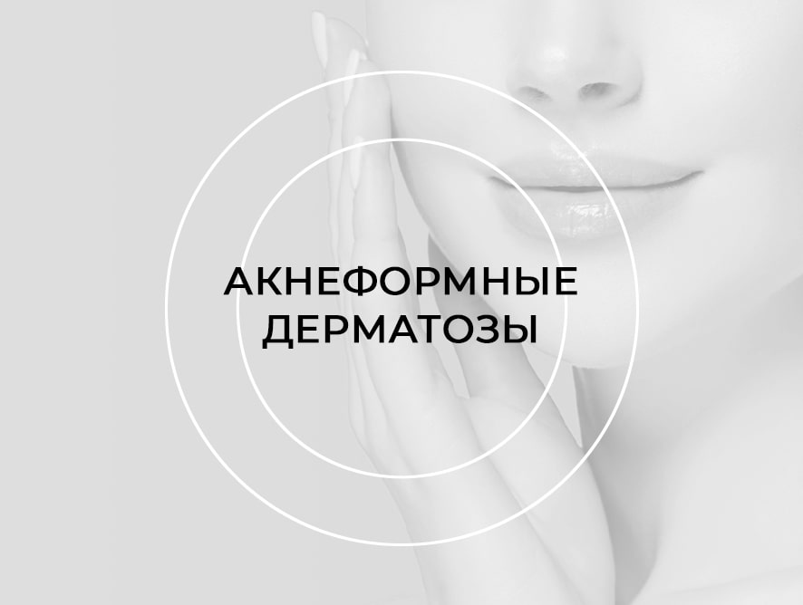 Школа «Акнеформные дерматозы»